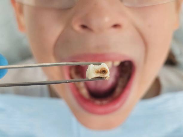 Best Emergency Tooth Extraction in Omaha, NE